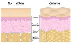 Cellulite Disappear