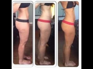 Cellulite Disappear