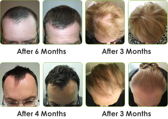 regrow hair protocol 